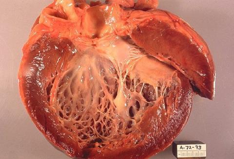 ما هي متلازمة القلب المكسور وما هي أعراضها